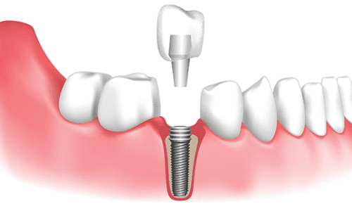 Types of Dental Implants: How to Choose the Best One for You