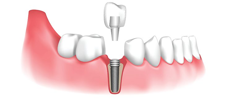 Types of Dental Implants: How to Choose the Best One for You