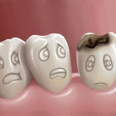 What You Need to Know About Tooth Decay