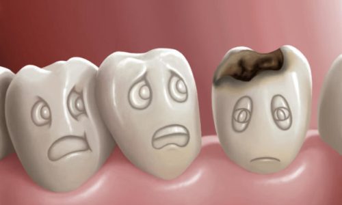 What You Need to Know About Tooth Decay