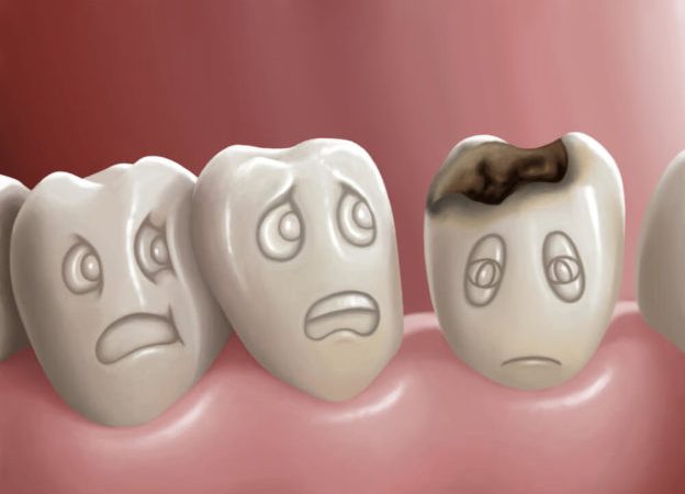 What You Need to Know About Tooth Decay