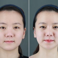Before & After: Witness the Astonishing Transformation through AB Plastic Surgery in Korea