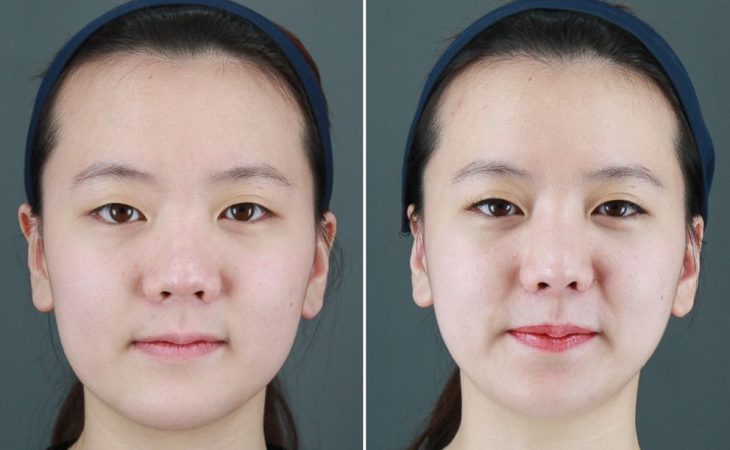 Before & After: Witness the Astonishing Transformation through AB Plastic Surgery in Korea