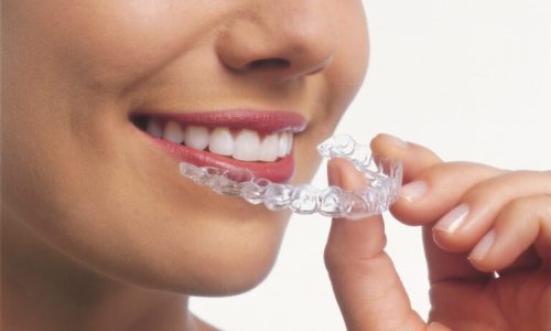 Why Hollywood is Choosing Invisalign Over Traditional Braces