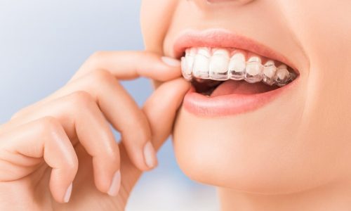Smile Transformation: How Invisalign at Sugarloaf Signature Dentistry Can Make Your Dreams Come True