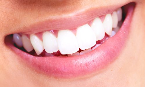 The Truth About MySmile Teeth Whitening Strips: How Effective Are They?