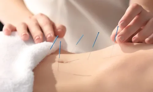 Why Acupuncture in Buena Park is Your Ultimate Pain Reliever
