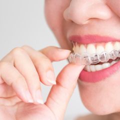 Top 5 Reasons to Choose Invisalign Over Traditional Braces