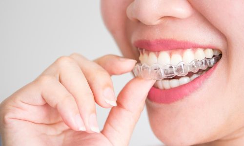 Top 5 Reasons to Choose Invisalign Over Traditional Braces