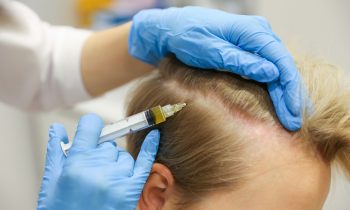 Hair Transplant Finance Options in London: What You Need to Know