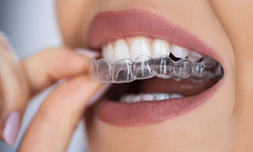 Why Invisalign Is a Game Changer for Adults Seeking a Perfect Smile