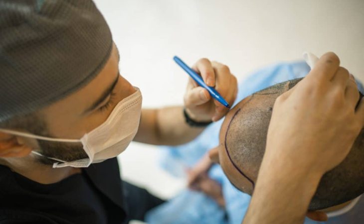 How to Find the Best Hair Transplant Clinic in the UK