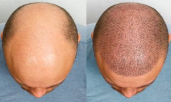 The Rise of the Best Hair Transplant London Providers