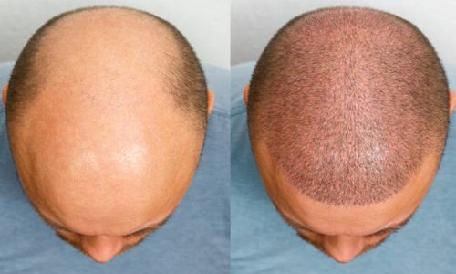 The Rise of the Best Hair Transplant London Providers