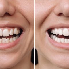 Everything You Need to Know About Treatment for Dental Veneers