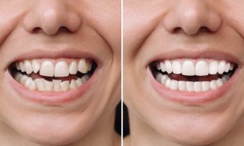 Everything You Need to Know About Treatment for Dental Veneers