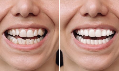 Everything You Need to Know About Treatment for Dental Veneers