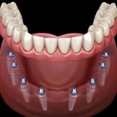 Discover the Advantages of All-on-x Dental Implants Over Other Options