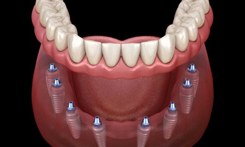 Discover the Advantages of All-on-x Dental Implants Over Other Options