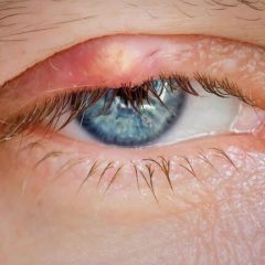 Innovations in Lens Replacement Surgery Techniques