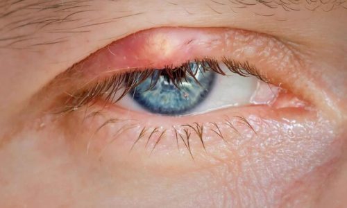 Innovations in Lens Replacement Surgery Techniques
