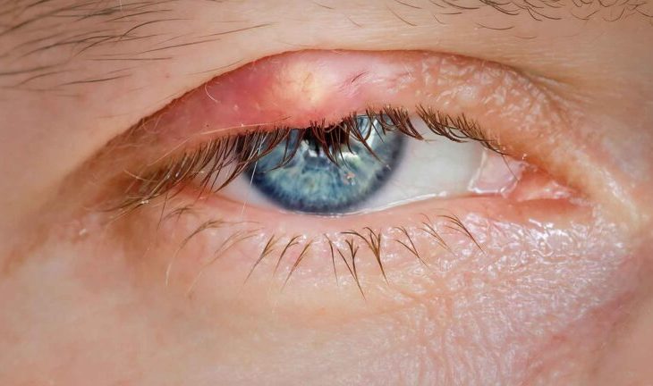 Innovations in Lens Replacement Surgery Techniques