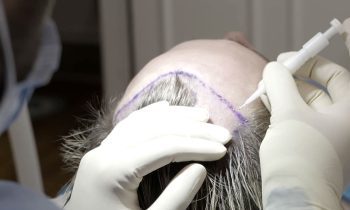 Top Reasons Why Birmingham Patients Choose Hair Transplant Surgery