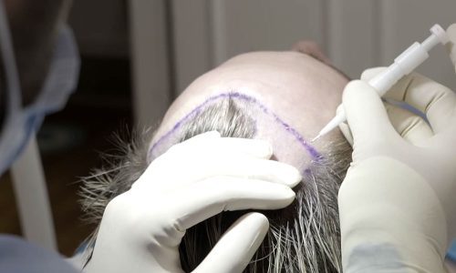 Top Reasons Why Birmingham Patients Choose Hair Transplant Surgery