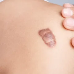 Top Medical Procedures for Effective Keloid Scar Treatment