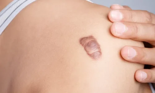 Top Medical Procedures for Effective Keloid Scar Treatment Top Medical Procedures for Effective Keloid Scar Treatment