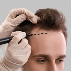 What Determines Hair Transplant Cost in London Clinics?