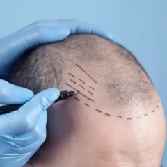 Understanding the Cost Factors of a Hair Transplant in 2026